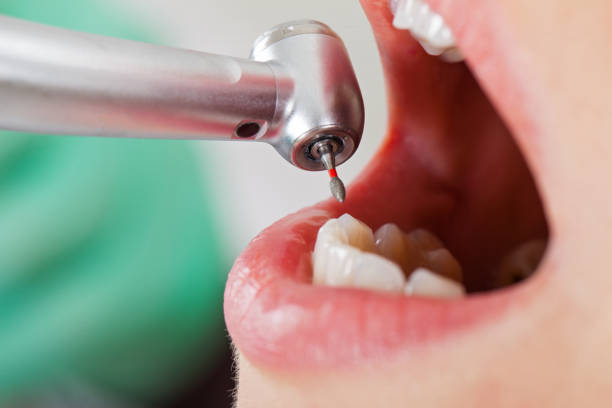 Best Emergency Tooth Extraction in Bargersville, IN